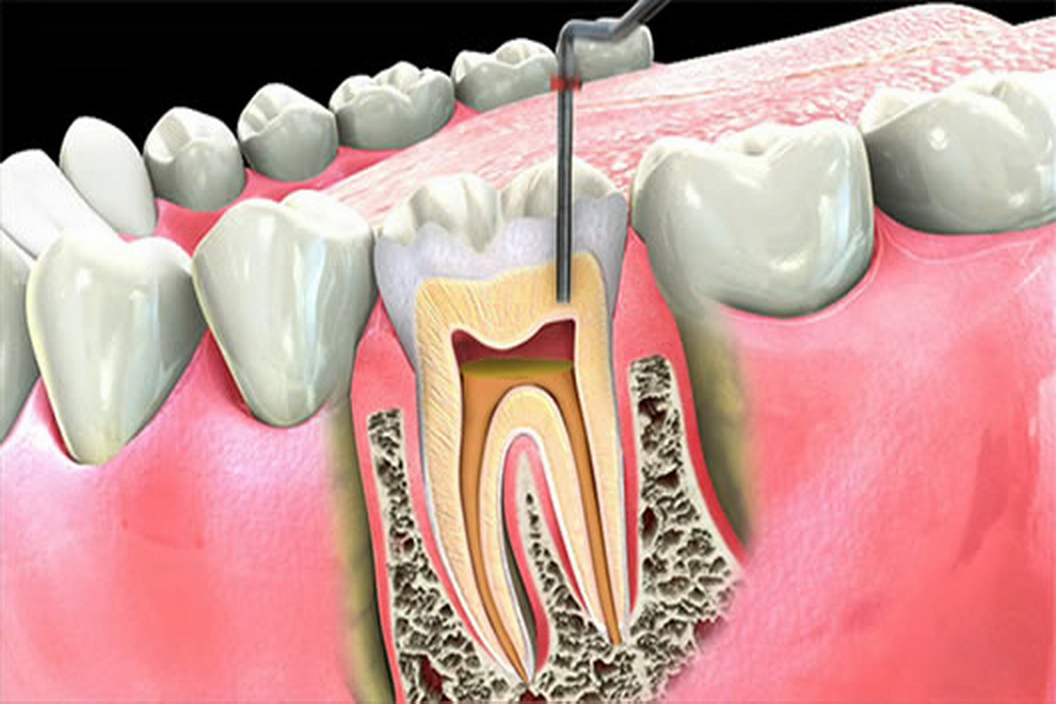 Root Canal Therapy Tooth Nerve