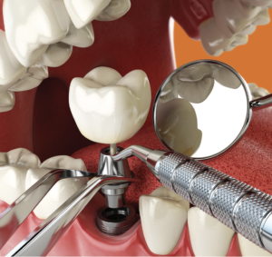 dental tooth implants