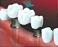 bridge placed on implants teeth
