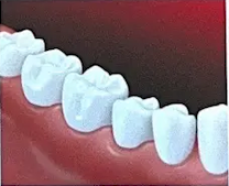 after the bridge is placed teeth