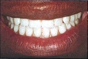 dentures placed on implants
