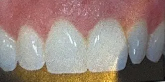tooth replaced by a dental implant and crown