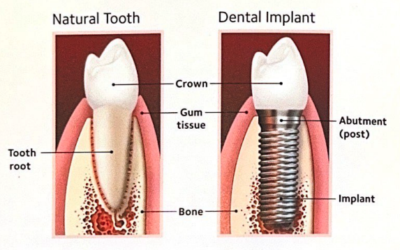 natural tooth and dental implant